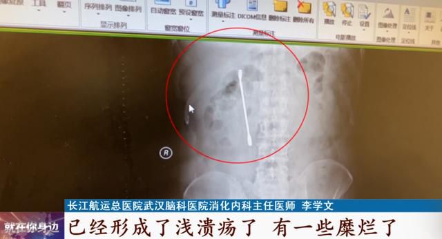 张嘴睡觉误吞20cm扳手尽不知道.
